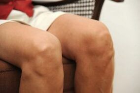 Πρήξιμο της άρθρωσης του γόνατος λόγω οστεοαρθρίτιδας